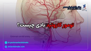 تومور کاروتید بادی چیست؟