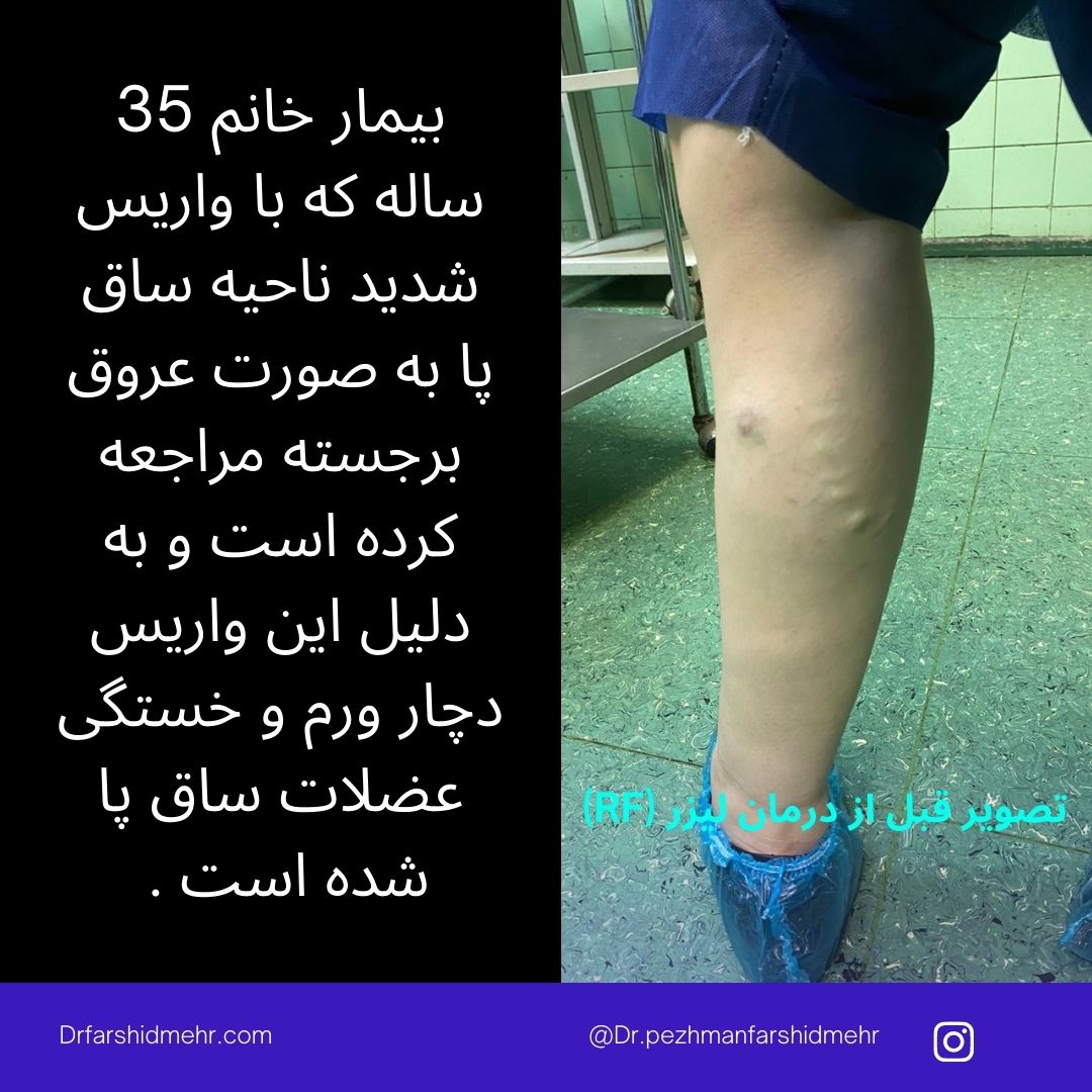 واریس شدید ناحیه ساق پا به صورت عروق برجسته