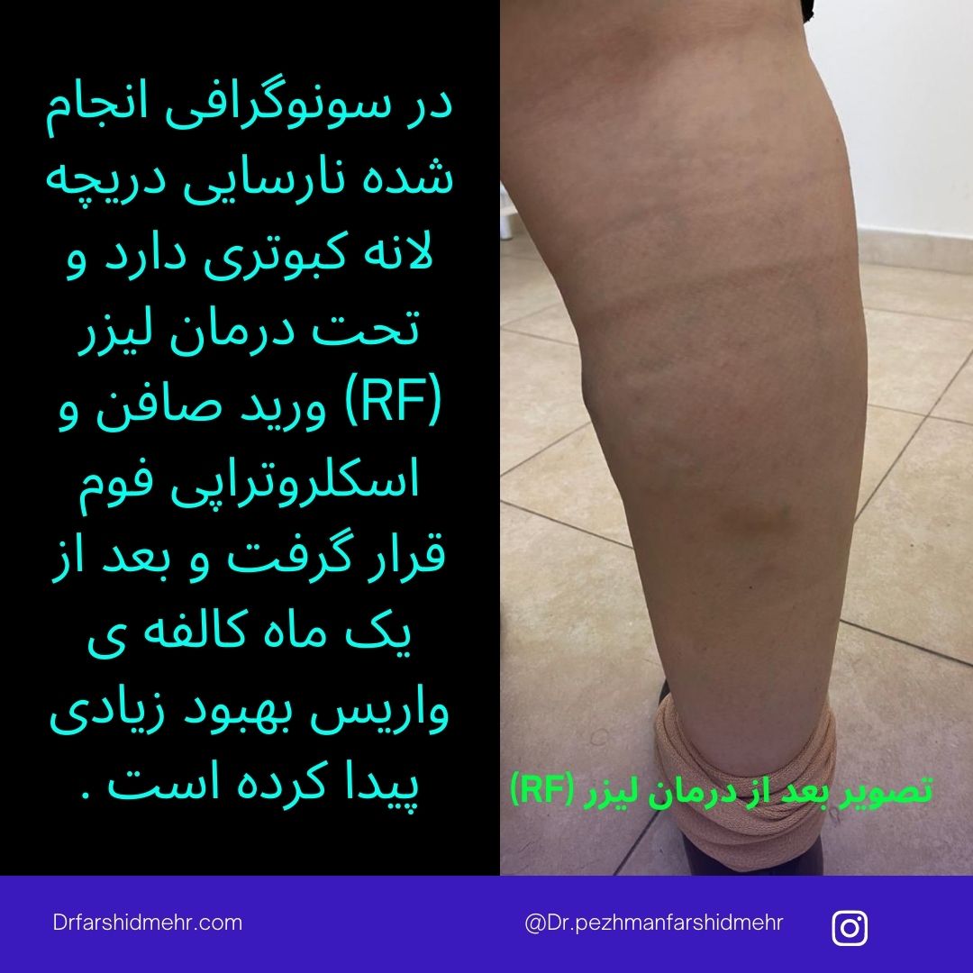 واریس شدید ناحیه ساق پا به صورت عروق برجسته